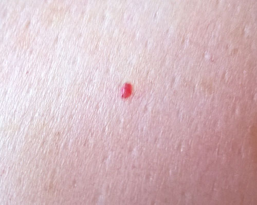 pinpoint red dots on skin that itch